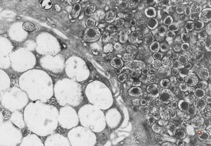 M,40y. | granular cell tumor M,40y. | granular cell tumor